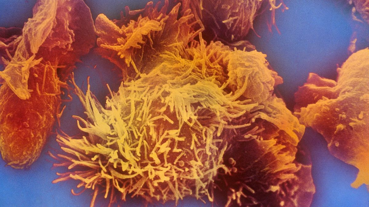 Metoda „molekulární sbíječky“ zničila v laboratoři 99 procent rakovinných buněk